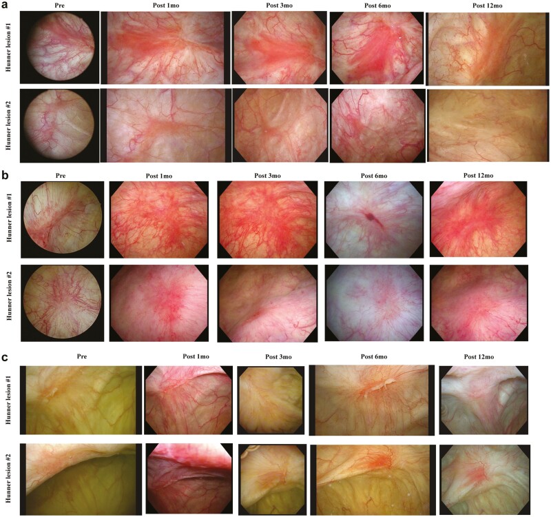 圖1：每位患者Hunner病變的連續膀胱鏡圖像。