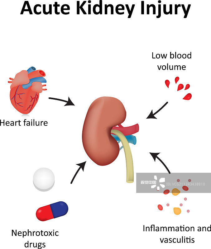 間充質干細胞治療急性腎損傷的臨床研究進展