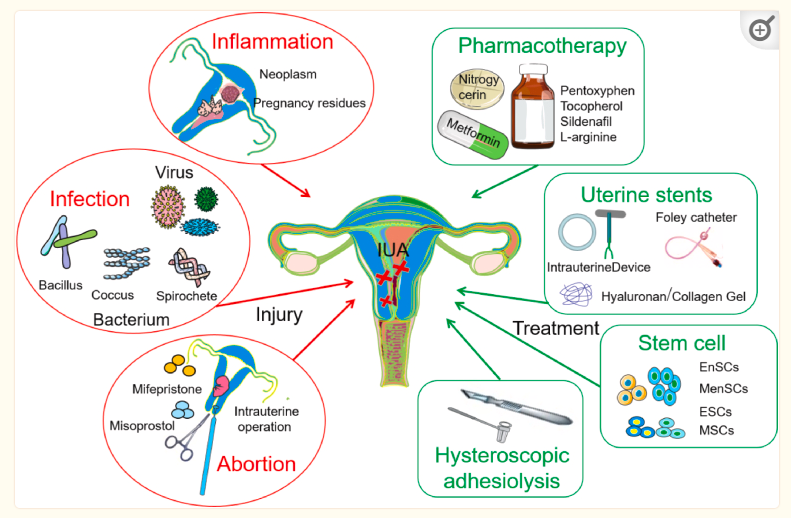 圖1：子宮內(nèi)膜損傷的機(jī)制及主要治療策略。