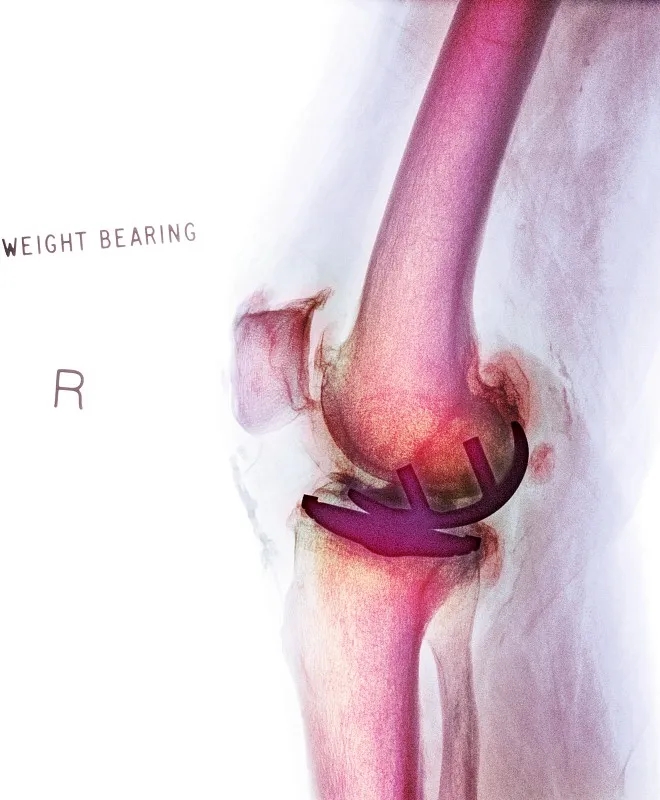 關節內移植干細胞治療膝骨關節炎：一項IIb期臨床試驗