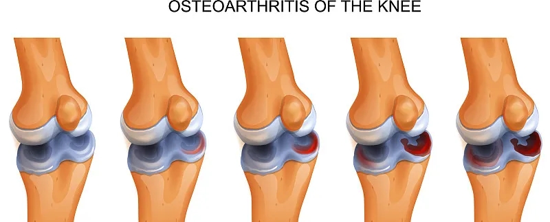 干細胞修復撕裂的無血管半月板軟骨：從體外優化到首次人體研究