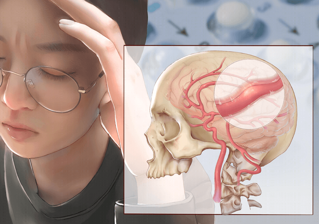 什么是偏頭痛？