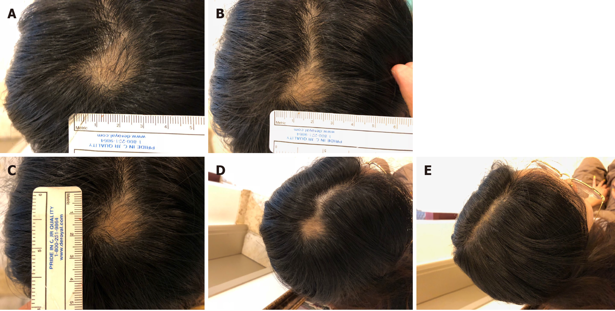 圖4：病例2治療期間和治療后病變部位可見(jiàn)變化。 