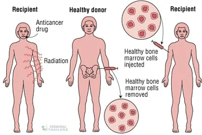 什么是造血干細胞和造血干細胞移植