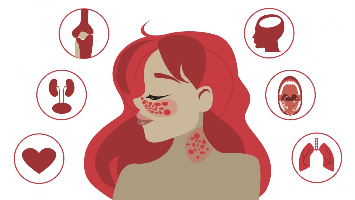 系統性紅斑狼瘡的癥狀是什么