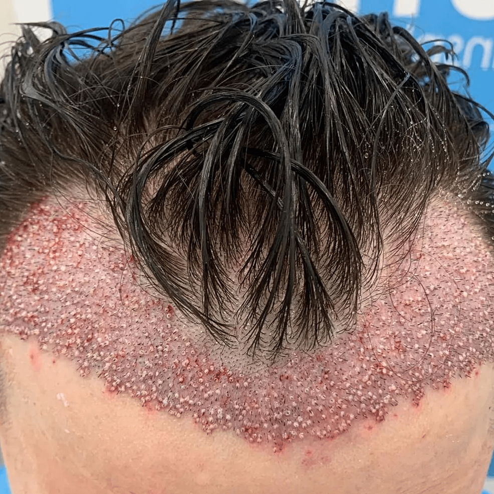 頭發(fā)移植手術(shù)后即刻的結(jié)果。——這允許在患者中建立更豐滿和更前的發(fā)際線