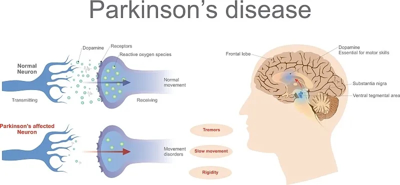 什么是帕金森病的再生醫學