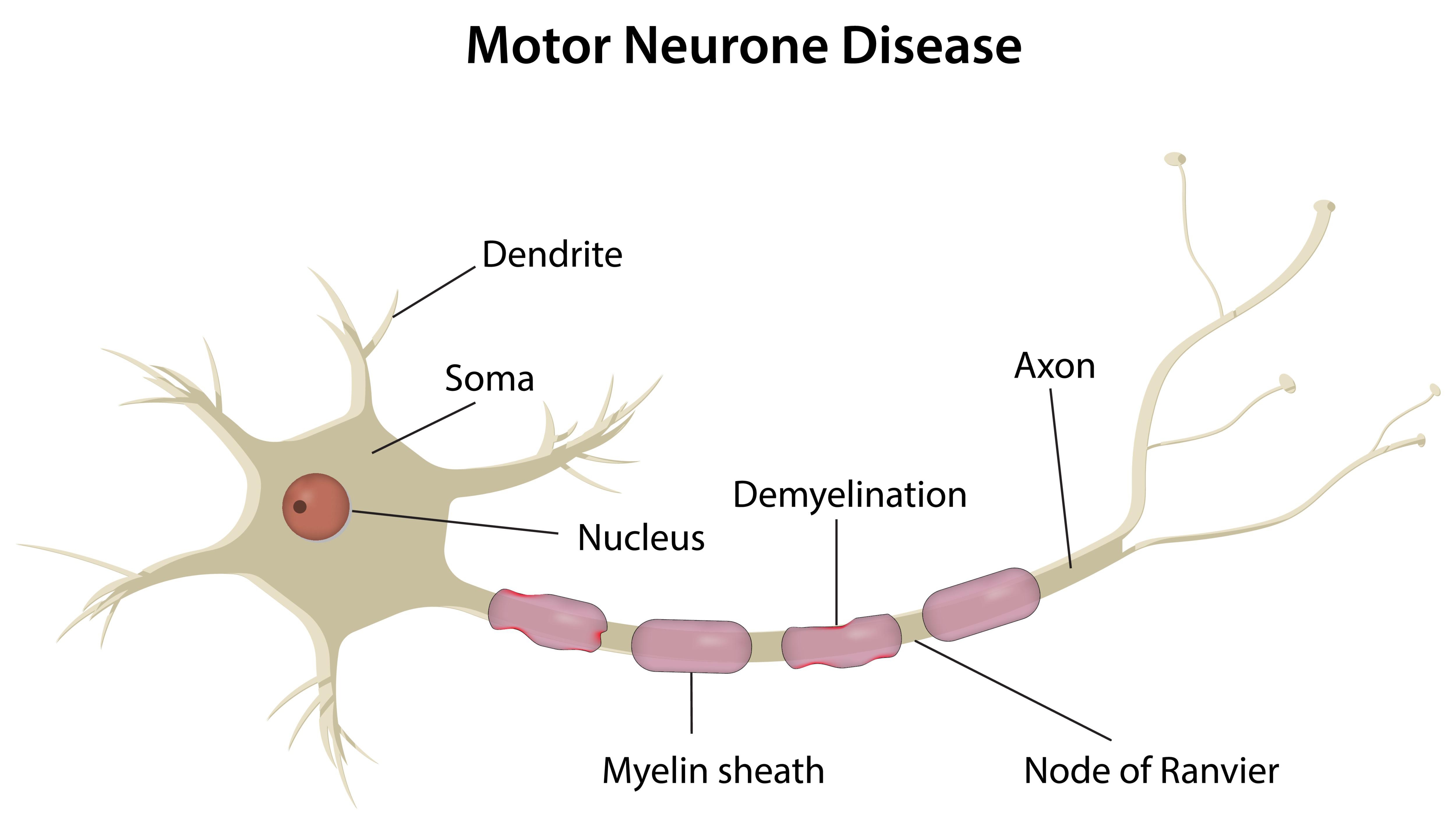 什么是運動神經元病? 什么是運動神經元病?