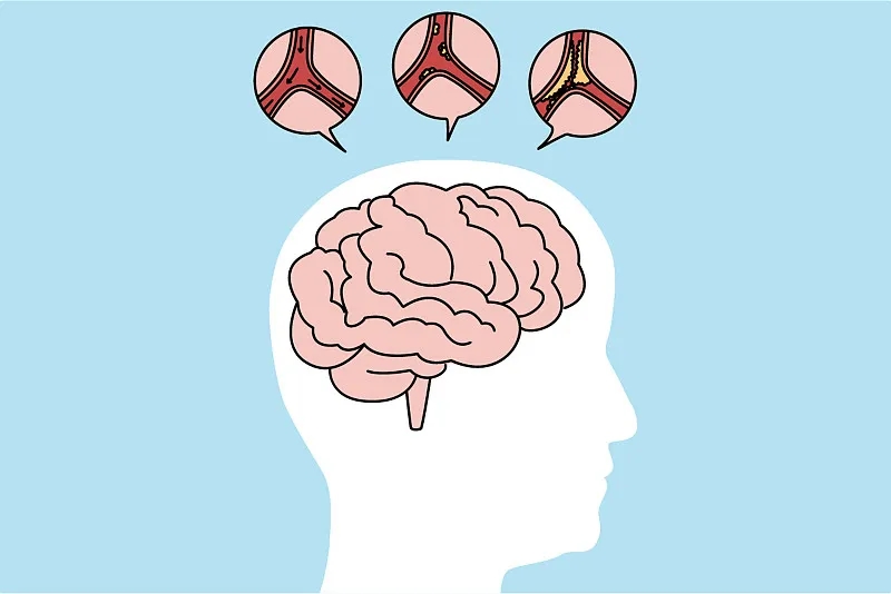 通過比較6、12、24個月的結果，來評估干細胞治療缺血性中風的有效性和安全性