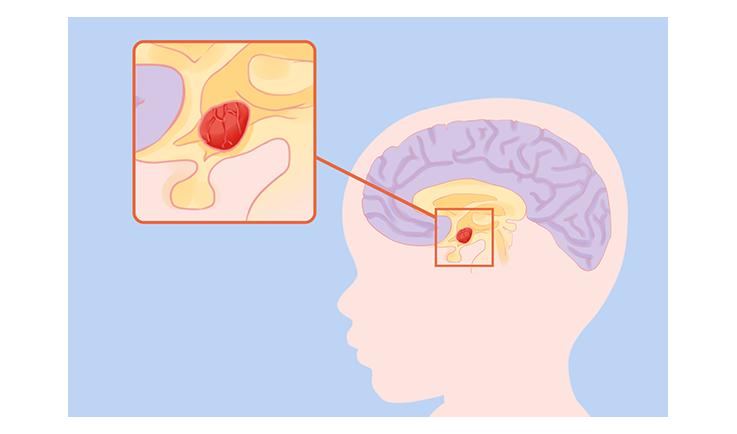 干細胞治療腦癱的成功率是多少？