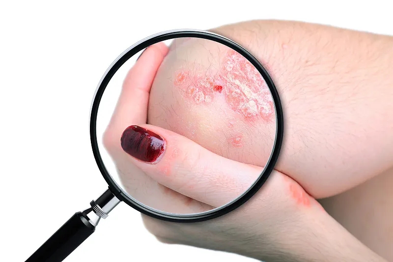 國內已有7項臨床研究項目，干細胞治療銀屑病，未來可期！