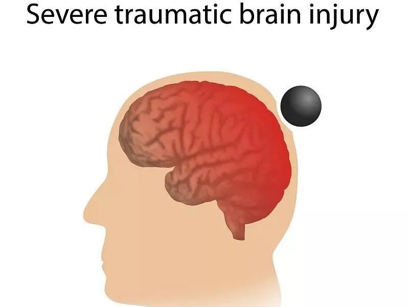 干細胞移植為缺血性腦損傷的治愈提供無限可能