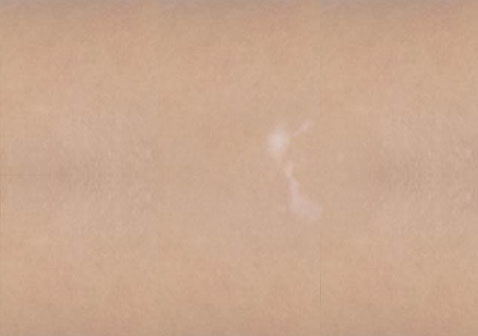 白癜風白斑初期癥狀輕微小斑點，無色素。