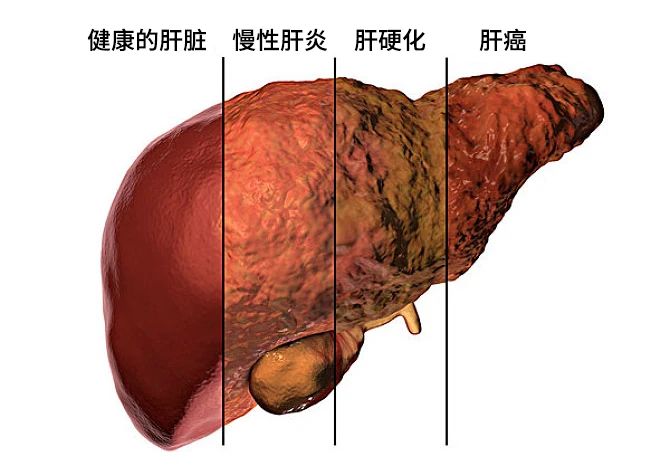 不同原因的肝損害發(fā)展主要分為三個階段：肝炎-肝硬化-肝癌。