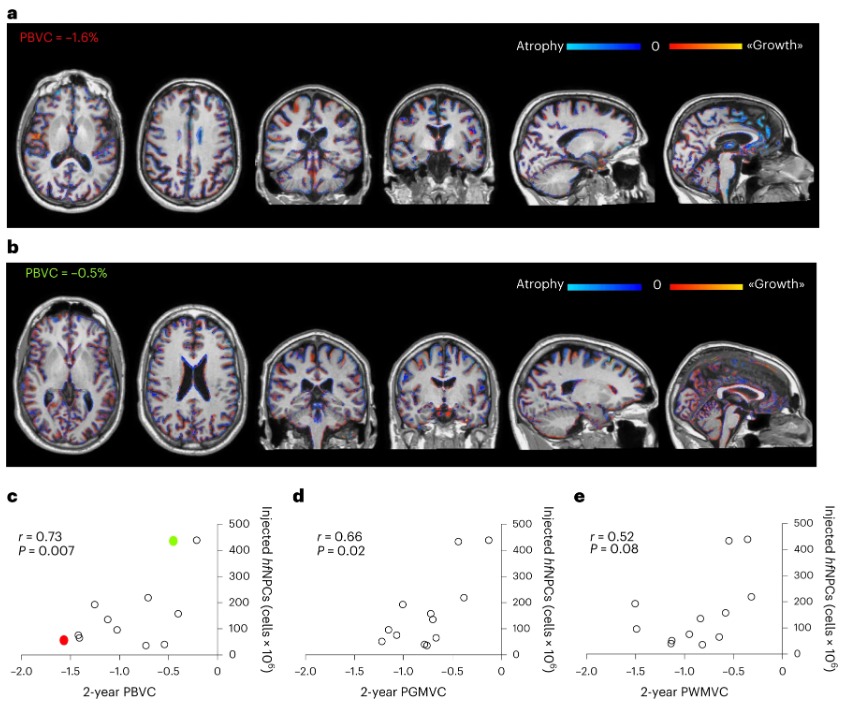 較低的腦萎縮與大量注射干細(xì)胞相關(guān)