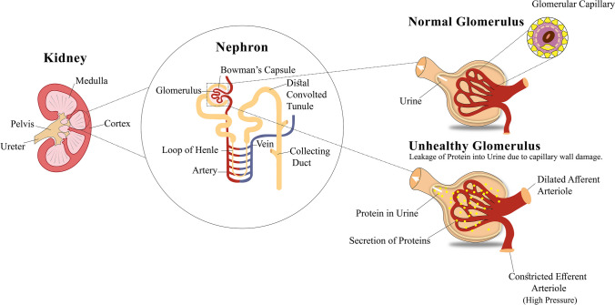 圖1：導(dǎo)致糖尿病腎病的原因，即糖尿病引起的腎臟疾病