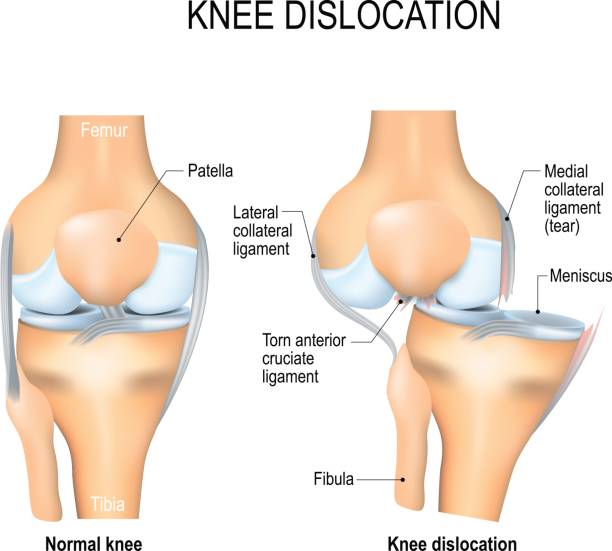 半月板撕裂后該如何恢復?