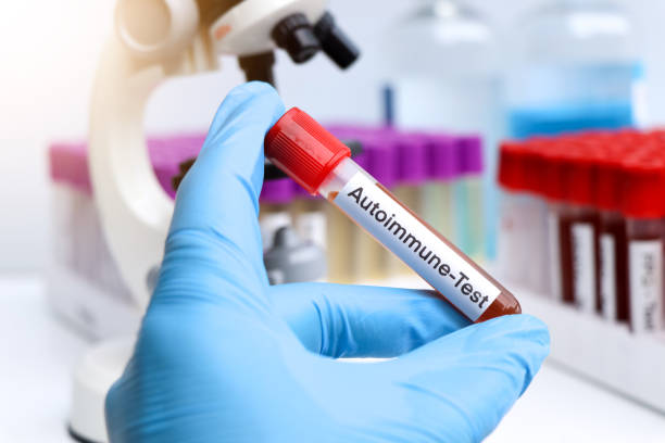 干細胞在類風濕關節炎、系統性紅斑狼瘡、銀屑病等自身免疫性疾病中的治療作用