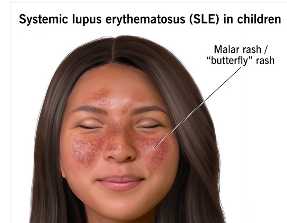 什么是兒童系統性紅斑狼瘡？及其病因和治療方法