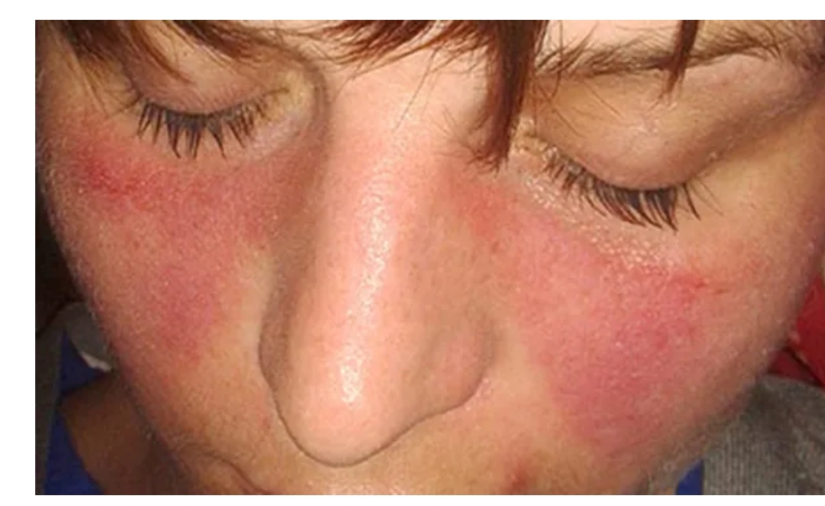 系統(tǒng)性紅斑狼瘡癥狀、病因和治療方法