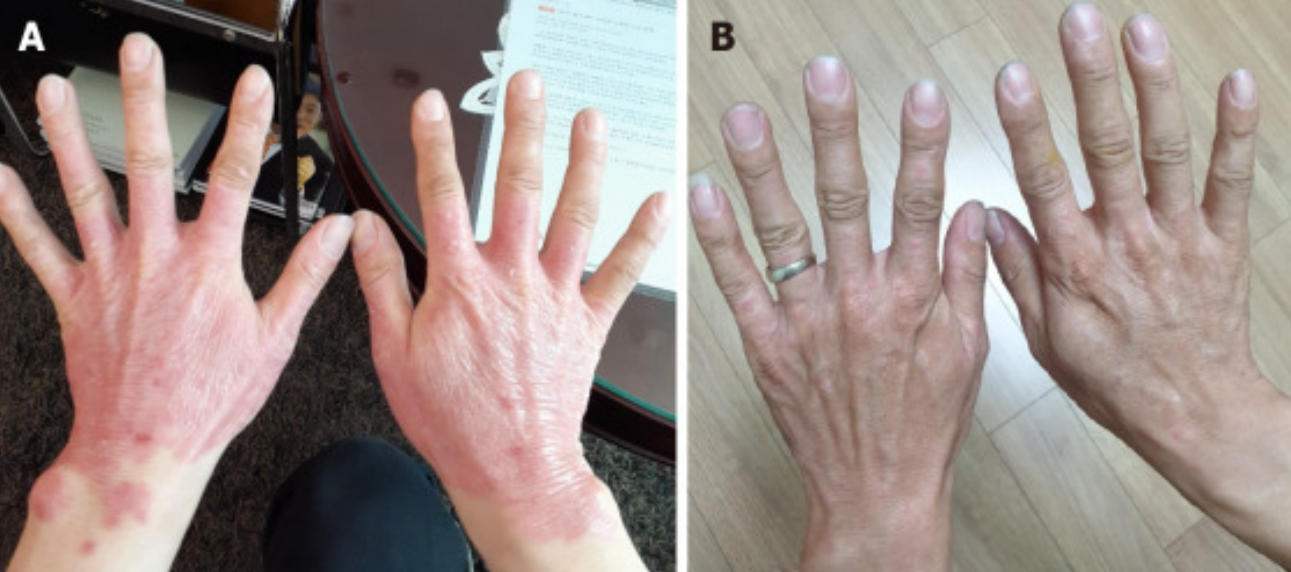 3次干細(xì)胞治療后25年?銀屑病頑疾得到顯著改善！