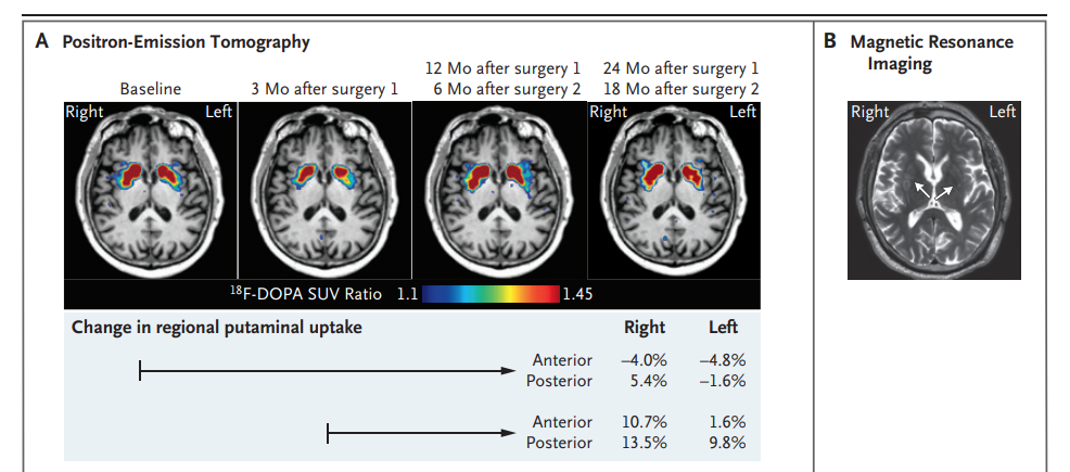 顯示了指示的時間點在基底神經節水平的軸向氟18-L-二羥基苯丙氨酸（18 F-DOPA）正電子發射斷層掃描圖像