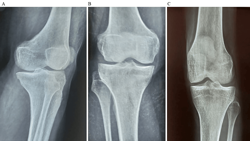 圖2：顯示了開始干細胞治療后骨骼的側視圖和前后視圖