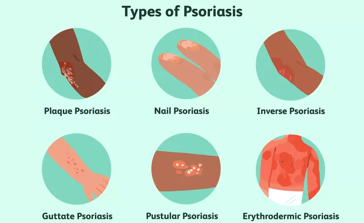 盤(pán)點(diǎn)國(guó)內(nèi)各大醫(yī)院運(yùn)用干細(xì)胞治療銀屑病的臨床應(yīng)用