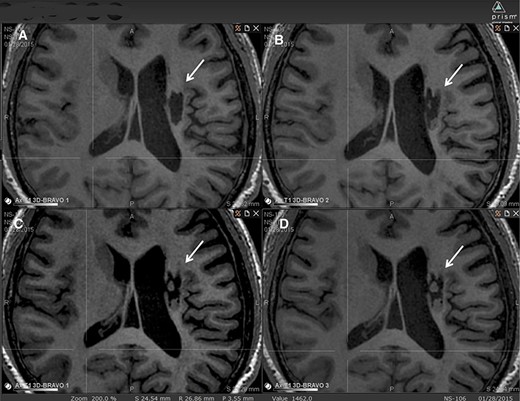 圖2：腔內(nèi)組織生長(zhǎng)的縱向MRI示例。