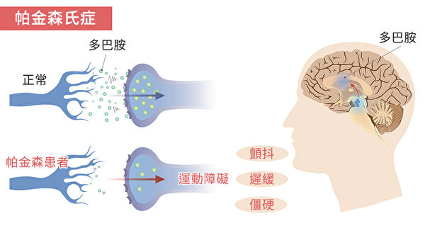 帕金森病 (PD) 的常見癥狀 帕金森病 (PD) 的常見癥狀