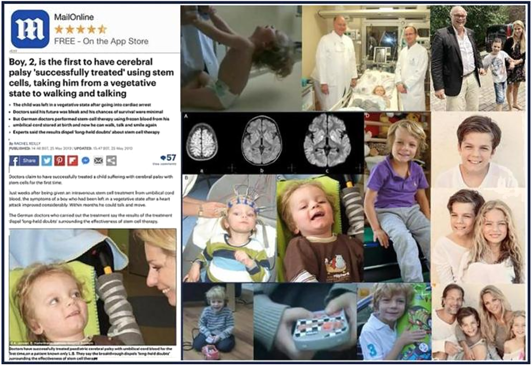 因心臟驟停引起的全身缺氧缺血而患上腦性癱瘓