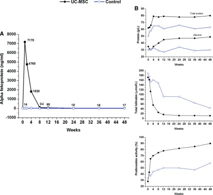 UC-MSC 輸血改善了一名急性慢性肝衰竭患者的血清 α-胎蛋白 (α-FP) 水平。