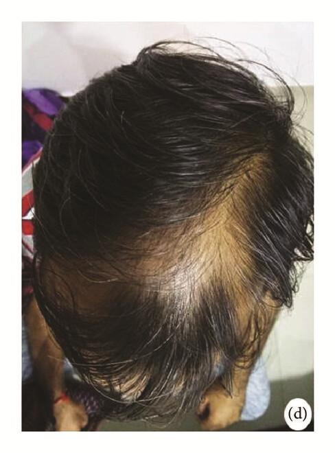 局部應(yīng)用骨髓間充質(zhì)干細(xì)胞一個月后，銀屑病消退，炎性紅斑完全清除（d）。