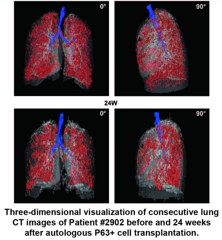 患者#2902在自體P63+細(xì)胞移植前后24周連續(xù)肺部CT圖像的三維可視化。