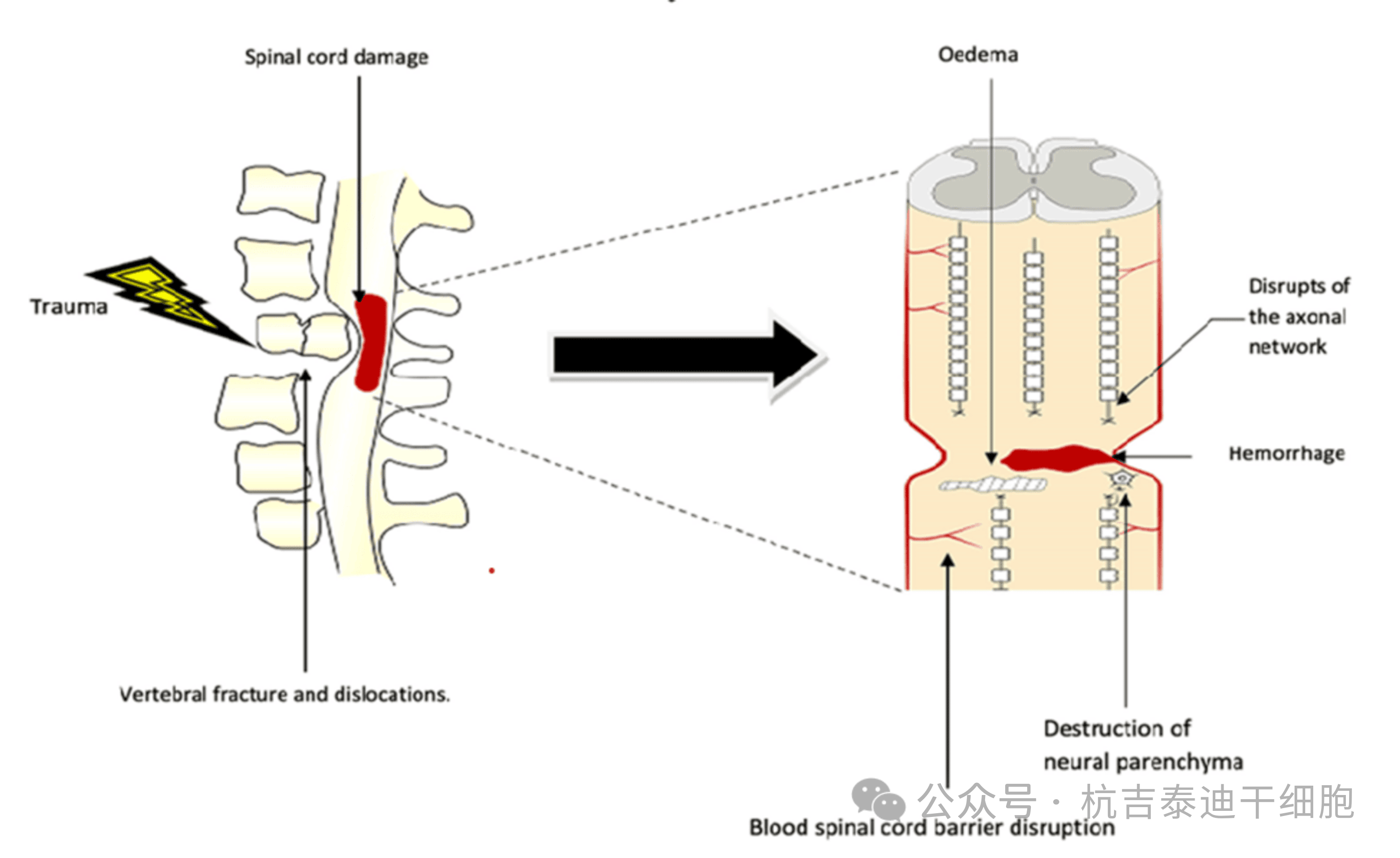 圖1：原發(fā)性病變，該圖顯示了創(chuàng)傷的直接影響，包括椎骨骨折、脫位和脊髓損傷導(dǎo)致軸突斷裂、水腫、出血和神經(jīng)實(shí)質(zhì)破壞