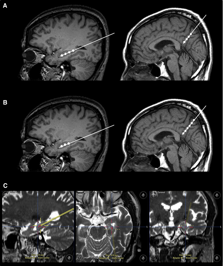 臍帶間充質(zhì)干細(xì)胞的立體定向給藥