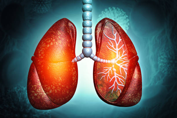 間充質(zhì)干細胞治療4大類肺部疾病的臨床試驗進展及挑戰(zhàn)