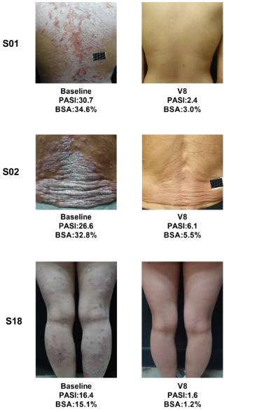 3 位患者治療前后的代表性皮膚圖像 3 位患者治療前后的代表性皮膚圖像