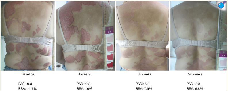 受試者治療前后的代表性皮膚圖像。 受試者治療前后的代表性皮膚圖像。