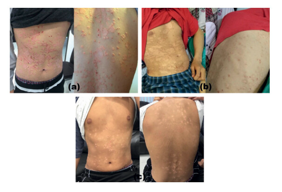 G-MSC 輸注對患有 5 年嚴重斑塊性銀屑病的 19 歲男性的影響。 G-MSC 輸注對患有 5 年嚴重斑塊性銀屑病的 19 歲男性的影響。