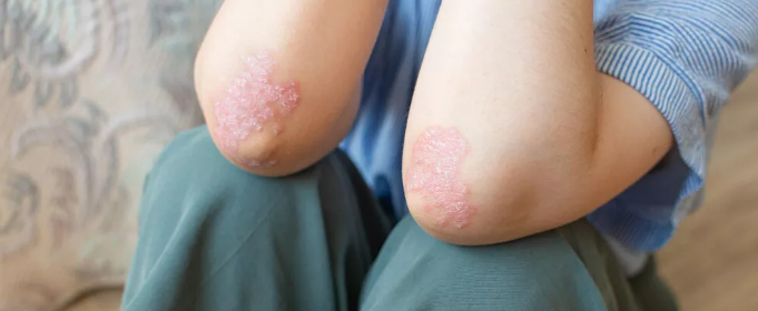 干細胞治療銀屑病:如何實現從短期銀屑病面積減少到長期皮膚恢復正常? 干細胞治療銀屑病:如何實現從短期銀屑病面積減少到長期皮膚恢復正常?