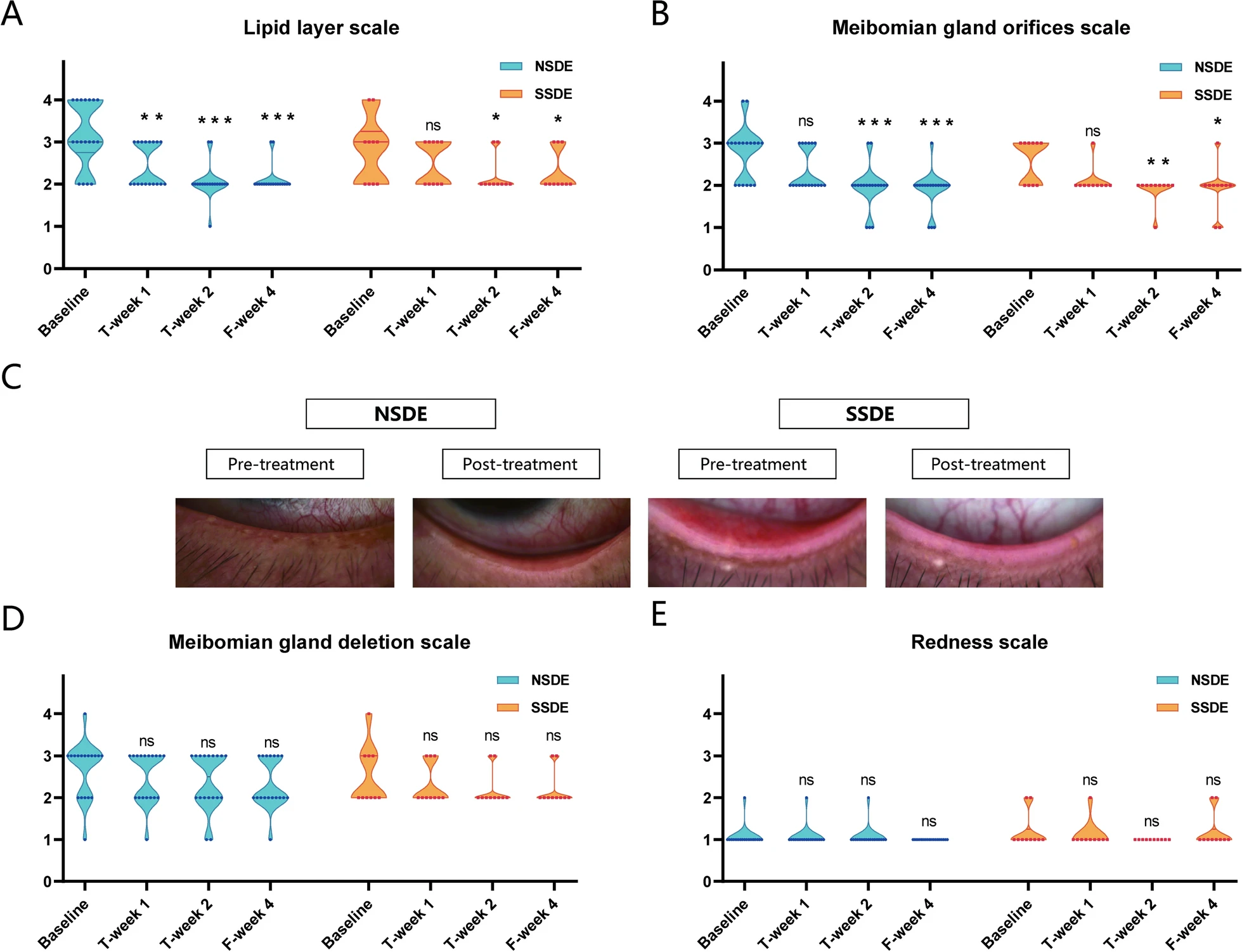圖3：NSDE和SSDE組基線(xiàn)、T第1周、T第2周和F第4周的脂質(zhì)層、瞼板腺和紅斑量表。