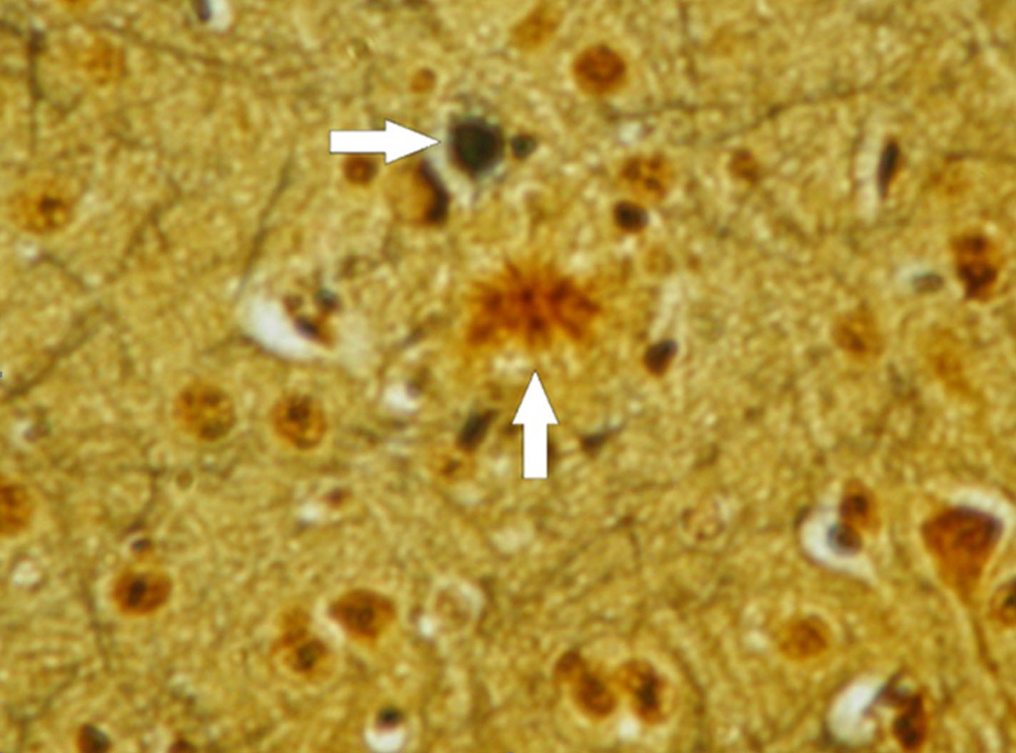 圖4：本圖描繪了三重轉基因小鼠模型中阿爾茨海默病的病理特征。