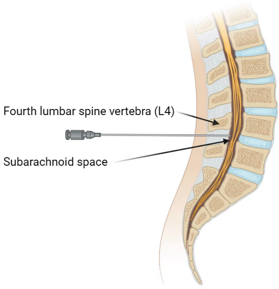 鞘內(nèi)細(xì)胞輸注