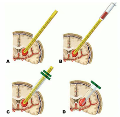 神經內鏡輔助下腦內血腫清除術示意圖