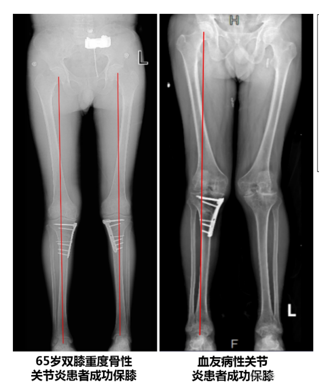 APTT-HTO脛骨高位截骨術