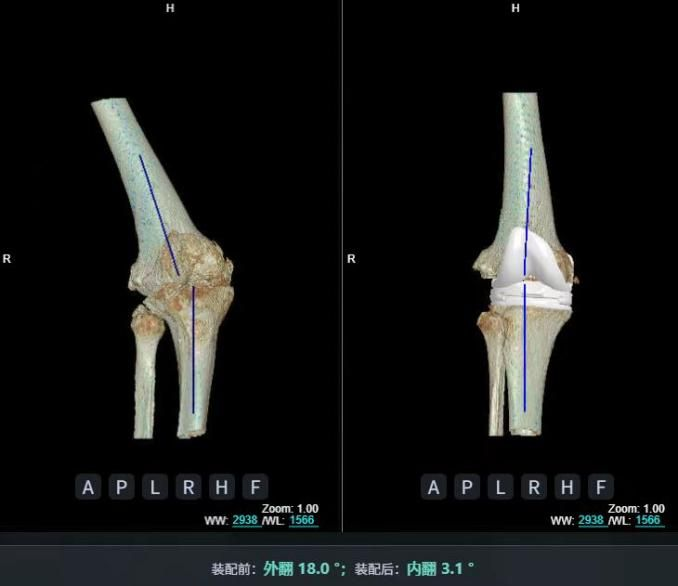AI精準關節置換