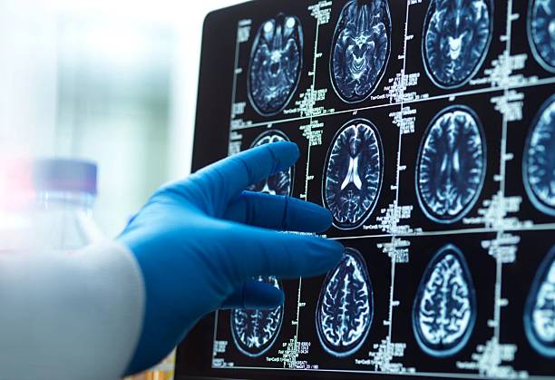 神經(jīng)干細(xì)胞移植十大常見問題解答:從原理到術(shù)后護(hù)理全知道 神經(jīng)干細(xì)胞移植十大常見問題解答:從原理到術(shù)后護(hù)理全知道