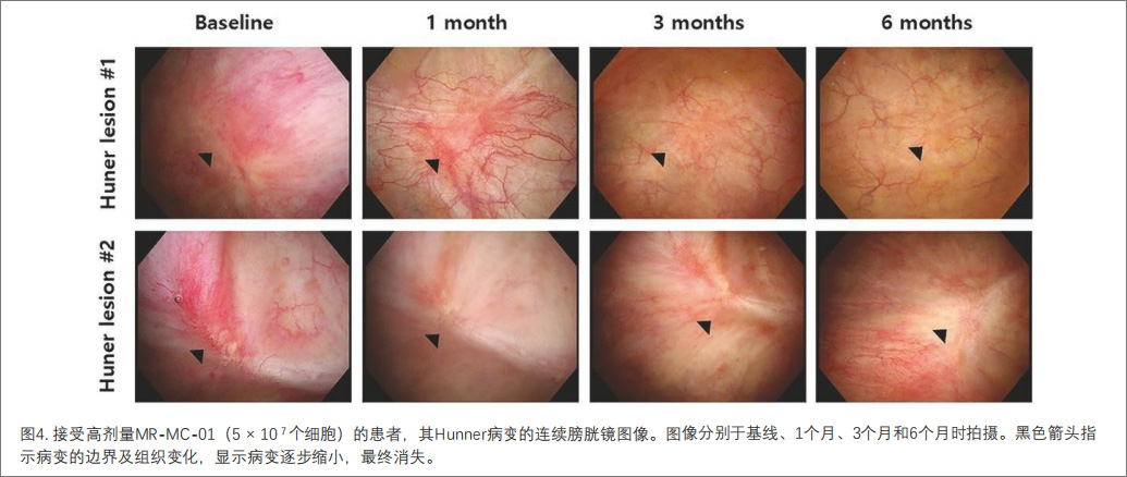間質(zhì)性膀胱炎臨床試驗(yàn)