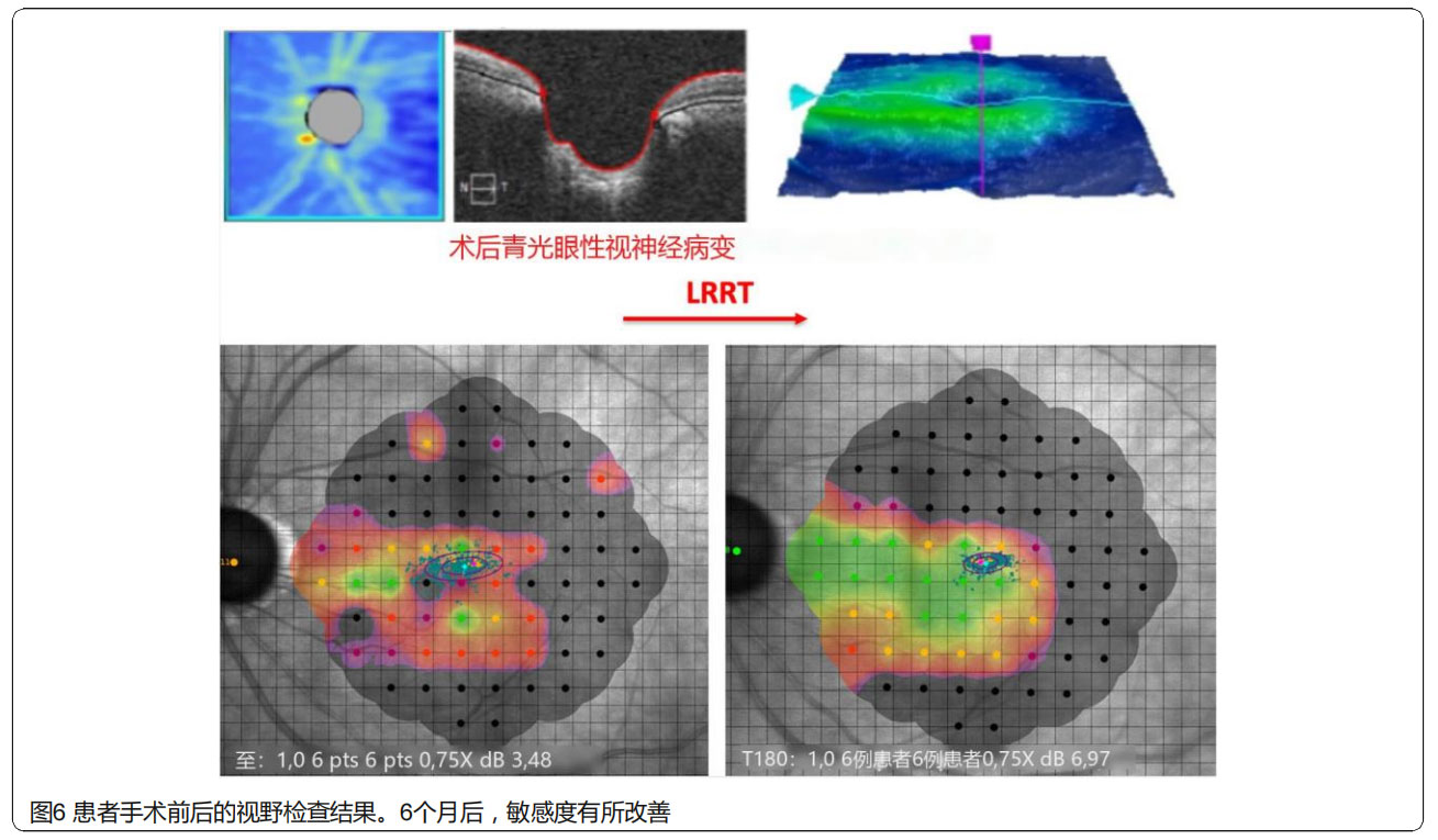 青光眼臨床試驗(yàn)